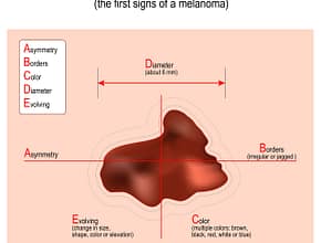 Melanoma signs and symptoms of Skin Cancer